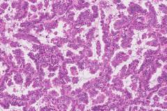 Adenocarcinoma of the lung