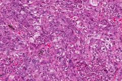 Adenocarcinoma of the lung