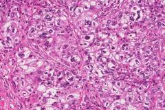 Adenocarcinoma of the lung