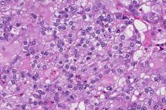 Adenocarcinoma of the lung