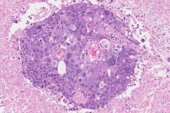 Metastatic adenocarcinoma of the lung to the brain