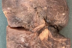 Adenocarcinoma of the lung