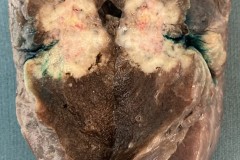 Adenocarcinoma of the lung