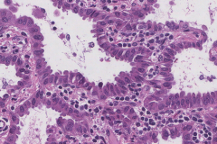 Adenocarcinoma of the lung: Papillary type