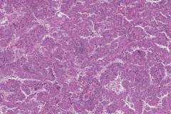 Adenocarcinoma of the lung: Papillary type