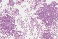Adenocarcinoma of the lung: Spread through airways
