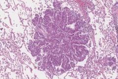 Adenocarcinoma of the lung: Spread through airways