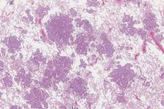 Adenocarcinoma of the lung: Spread through airways