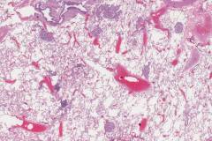 Adenocarcinoma of the lung: Spread through airways