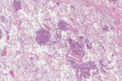 Adenocarcinoma of the lung: Spread through airways