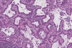 Adenocarcinoma of the lung: Papillary type