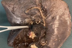 Adenocarcinoma of the lung
