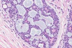 Adenoid cystic carcinoma of the breast