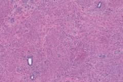 Adenomyoma of the uterus