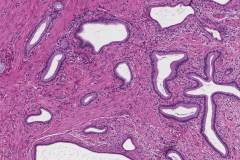Adenomyosis of the gallbladder
