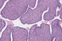 Adenosarcoma of the cervix
