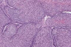 Adenosarcoma of the cervix