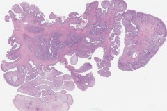 Adenosarcoma of the cervix