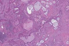 adenosquamous carcinoma Archives | Ottawa Atlas of Pathology
