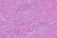 Adenosquamous carcinoma of the pancreas