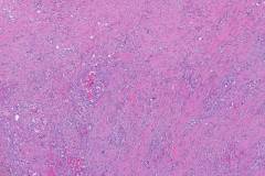 Adenosquamous carcinoma of the pancreas