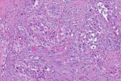 Adenosquamous carcinoma of the pancreas