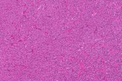 Adrenal cortical carcinoma