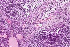 Alveolar rhabdomyosarcoma