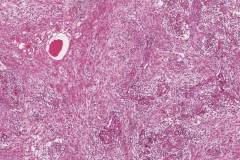 Ameloblastoma