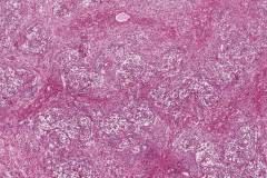 Ameloblastoma
