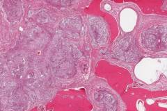 Ameloblastoma
