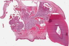 Ameloblastoma
