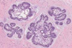 Ameloblastoma