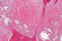 Ameloblastoma eroding bone