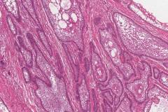 Follicular type ameloblastoma