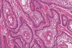Follicular type ameloblastoma