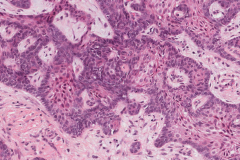 Ameloblastoma