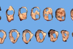 Ameloblastoma involving the mandible