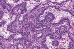 Ameloblastoma