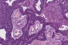 Ameloblastoma
