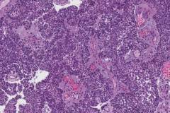 Ameloblastoma