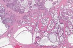 Follicular type ameloblastoma