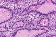 Ameloblastoma