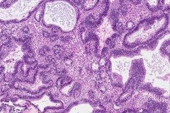 Ameloblastoma