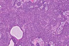 Ameloblastoma