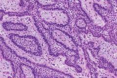 Ameloblastoma