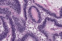 Ameloblastoma