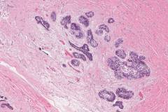 Ameloblastoma arising in the background of a radicular cyst