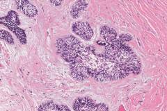 Ameloblastoma arising in the background of a radicular cyst