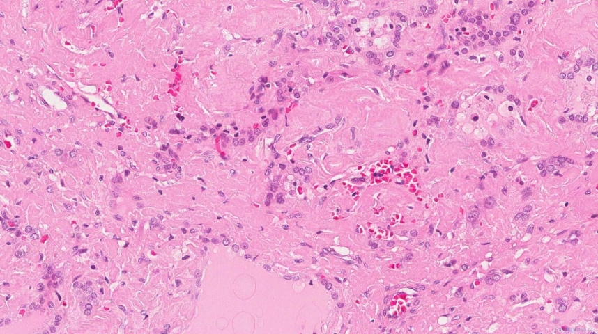 Amyloidoma of the thyroid gland